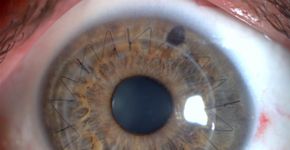 Campanha por doação de córnea espalha olhos pela cidade