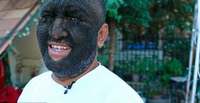 Homem com doença genética rara tem 98% do corpo coberto de pelo