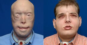 Homem recebe transplante de rosto mais extensivo da história
