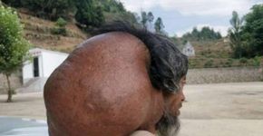 Depois de 47 anos, chinês retira tumor de 15 kg da nuca