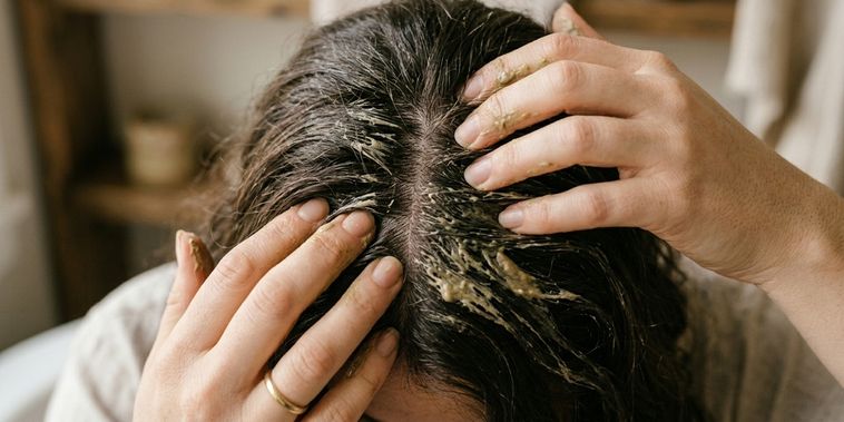 Featured main: Adeus à caspa para sempre: a mistura caseira, sem corantes nem produtos químicos, para eliminá-la em um dia