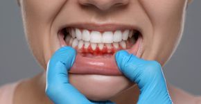 Gengiva escura: o que causa e como prevenir?
