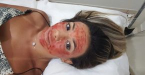 Fabiana Teixeira faz tratamento com seu próprio sangue no rosto