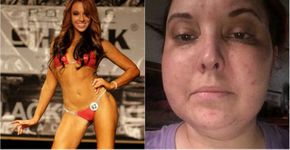 Modelo ganhou 20 kg em 1 ano por causa de tumor não diagnosticado