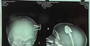 Um acidente raro: uma tomada no crânio de um bebê