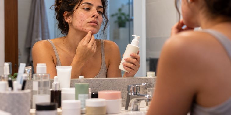 Featured main: Acne em adultos: alterações hormonais e resistência à insulina podem influenciar o surgimento de espinhas além do consumo de chocolate
