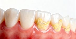 Essa mistura caseira amolece tártaro inicial dos dentes, mas precisa seguir uma rotina para não danificar