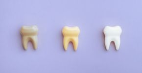 5 mitos e verdades sobre manchas nos dentes