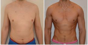 Com dieta radical, jovem perde 75% de sua gordura corporal em apenas 3 meses