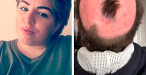 Mulher tem queimadura séria após tentar fazer cabelo de unicórnio