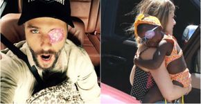 Bruno Gagliasso usou tampão no olho para apoiar a filha Titi