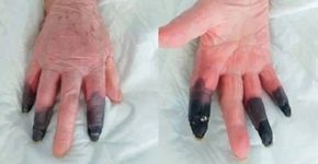 Foto: (reprodução/European Journal of Vascular and Endovascular Surgery)