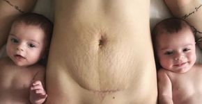Puérpera posta foto de estrias e marca de cesárea e viraliza