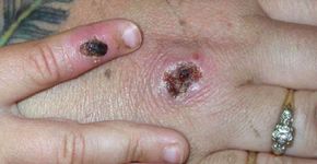 Foto: (reprodução/CDC)