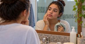 Pele cheia de espinhas? Dermatologistas destacam um hábito diário que muitos jovens acabam deixando de lado