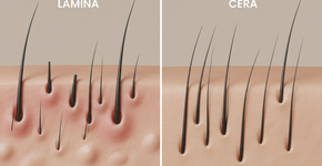Lâmina ou cera qual método mais causa pelos encravados?