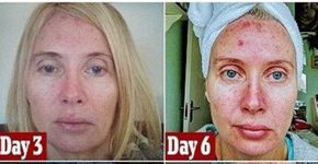 Mulher mostra o resultado do vício em se bronzear no sol