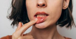 Gengivite: doença leva à perda de dentes; entenda os motivos