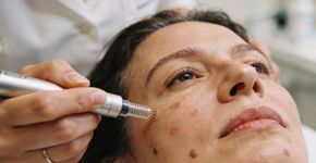 Microagulhamento x peeling químico, qual é melhor para manchas de acne?
