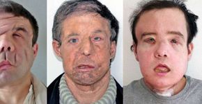 Primeiro homem a fazer 2 transplantes de rosto mostra resultado