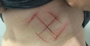 Suástica feita em jovem por fãs de Bolsonaro é fake news