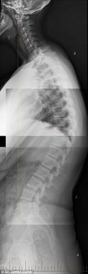 Espinhas dorsais completamente curvadas que resultam em problemas graves de coluna e para o pescoço é a principal consequência da tecnologia para a saúde da nova geração (Reprodução/The Daily Mail) 