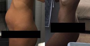 Cirurgia de endometriose suspende uso de medicamentos