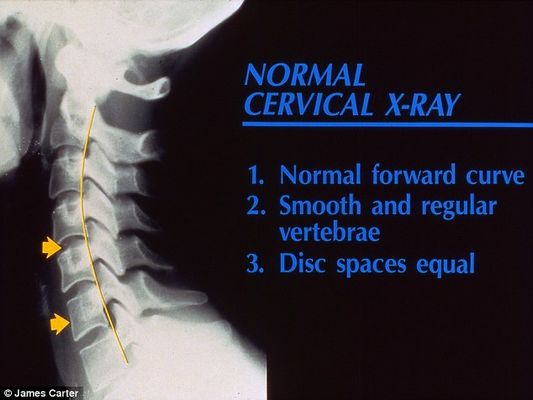Espinhas dorsais completamente curvadas que resultam em problemas graves de coluna e para o pescoço é a principal consequência da tecnologia para a saúde da nova geração (Reprodução/The Daily Mail) 