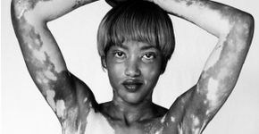 Fotógrafa com vitiligo retrata a beleza de quem sofre com a doença