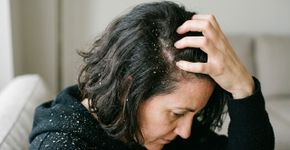 Acabe com a coceira: um método para tratar a caspa em casa