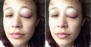 Modelo faz alerta após tatuagem no branco do olho infeccionar