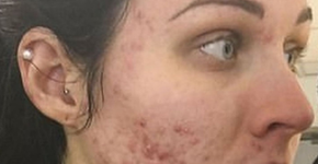 Jovem desenvolve problema grave de acne da noite pro dia