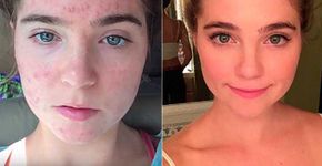 Gêmeas curam acne severa apenas com mudança na alimentação