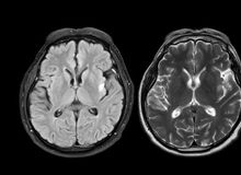 Featured side: Cientistas descobriram um novo gatilho para o Alzheimer e um medicamento que o inibe