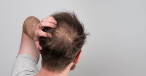 Quais bebidas contribuem para a queda de cabelo? Estudo responde