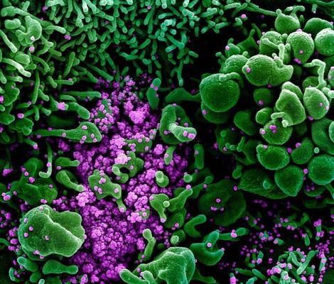 Imagem mostra coronavírus atacando células humanas em amostra de paciente contagiado 