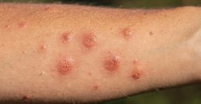 5 cuidados simples para aliviar picadas de mosquito rapidamente