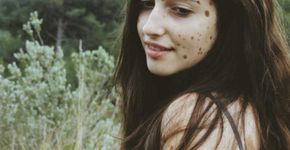 Jovem com condição rara supera o bullying e se torna modelo