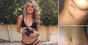 Modelo mostra cicatrizes e alerta contra bronzeamento artificial
