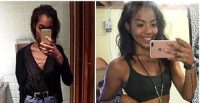 Jovem vence anorexia e posta ‘antes e depois’ para comemorar