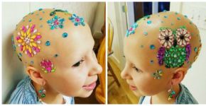 Careca brilhante: menina com doença autoimune cria novo visual