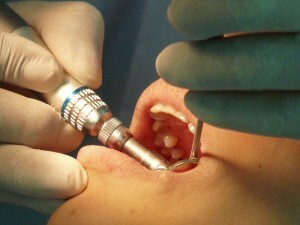 Tratamentos de cáries, canal, gengivite, colocação de implantes e cirurgias avançadas