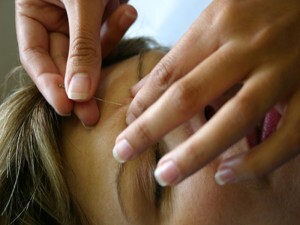 A acupuntura é o ramo mais tradicional da medicina chinesa