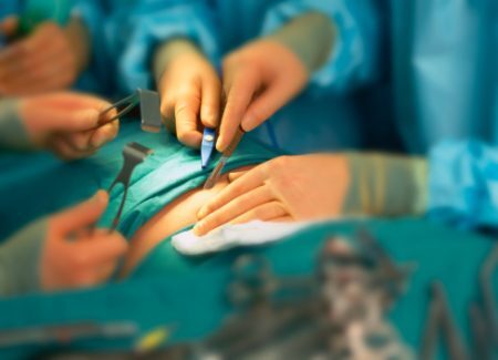 Segundo a SBCBM, atualmente, 13,05% dos pacientes têm complicações após ou durante a cirurgia