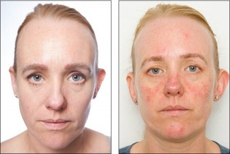 Antes e depois: os danos da maquiagem na pele da repórter