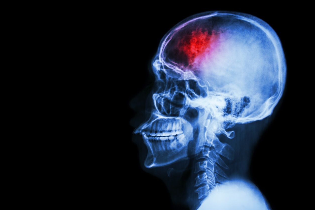 ilustração de um corpo humano com uma marca vermelha no cérebro