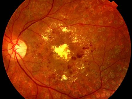 Retinopatia diabética pode levar à cegueira