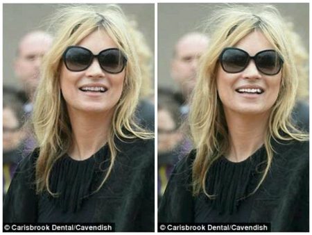 Voluntários disseram que Kate Moss, de 41 anos, parece ter 35 na foto em que seus dentes estão digitalmente mais brancos