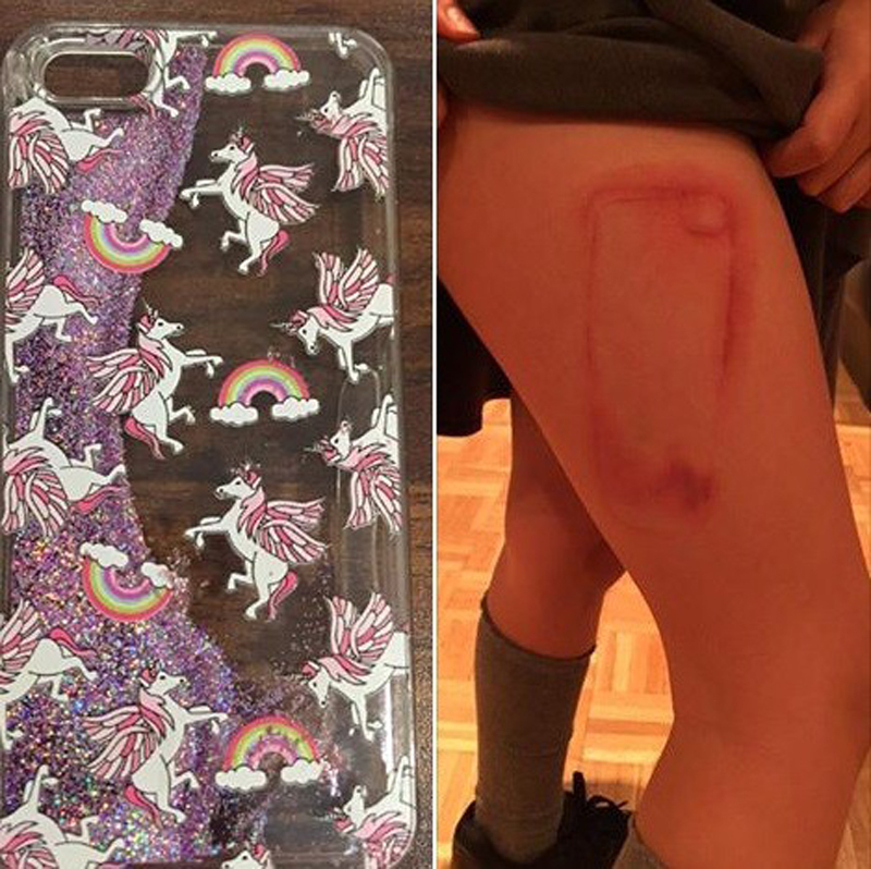 Menina tem queimadura na perna após dormir com iPhone no bolso