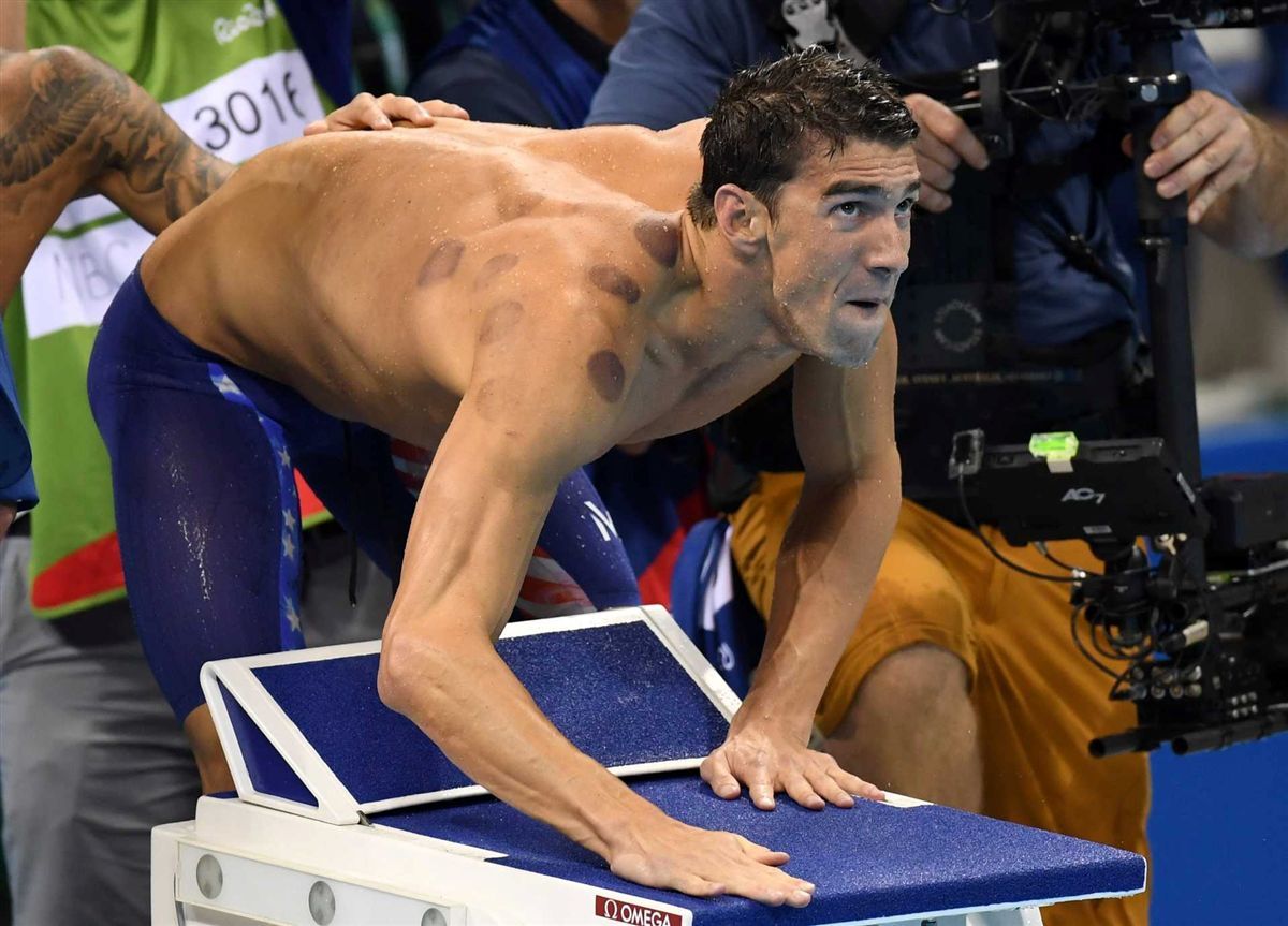 Manchas no corpo de Michael Phelps são resultado de tratamento por ventosaterapia